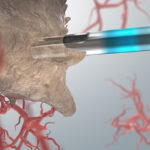 MEDICINTEKNIK: Nästa generations biopsisystem – om NeoDynamics, Etteplan och ett ingenjörsarbete som gjort skillnad